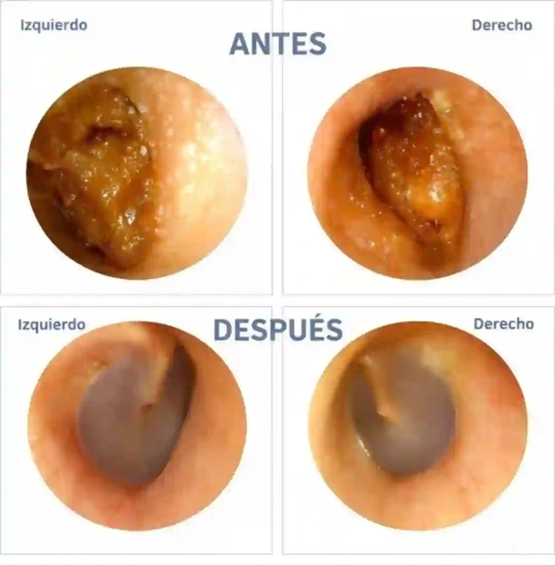 LIMPIADOR DE OÍDOS INTELIGENTE CON CÁMARA HD