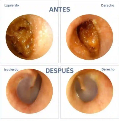 LIMPIADOR DE OÍDOS INTELIGENTE CON CÁMARA HD